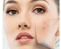 проблемная кожа лица: лечение прыщей и угрей